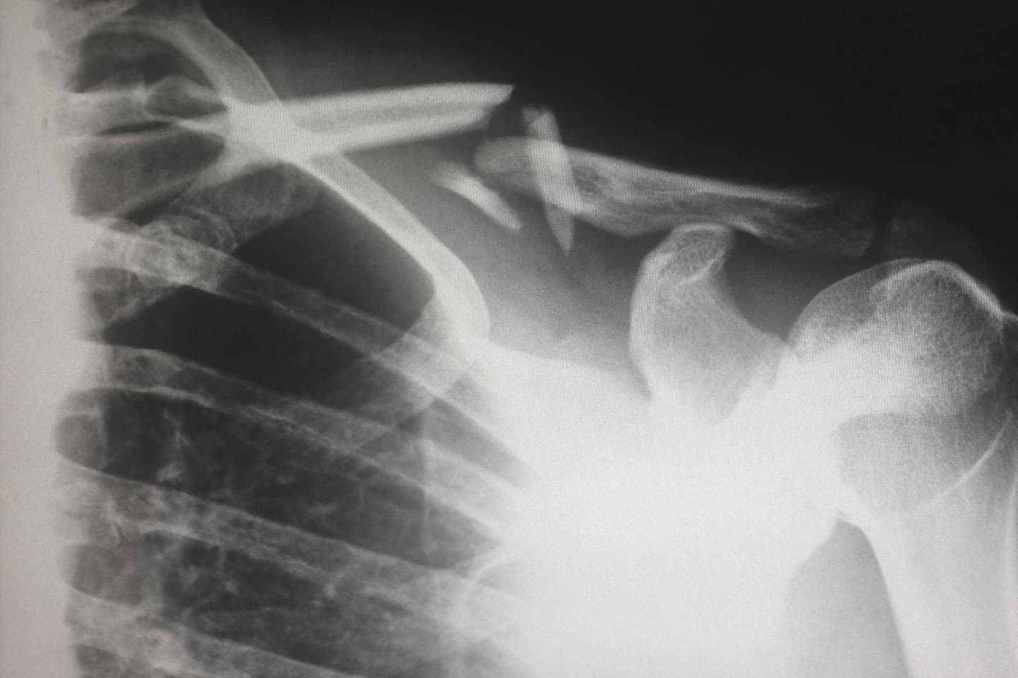 an x-ray of a broken shoulder bone