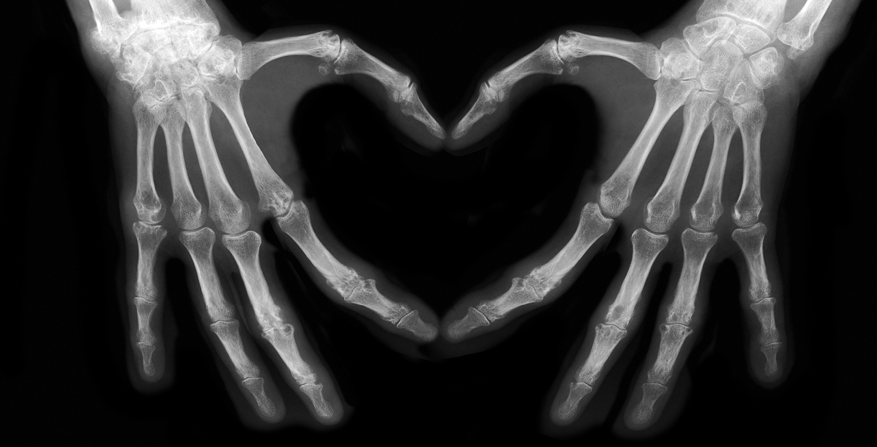 x-ray image of two hands making the shape of a heart.