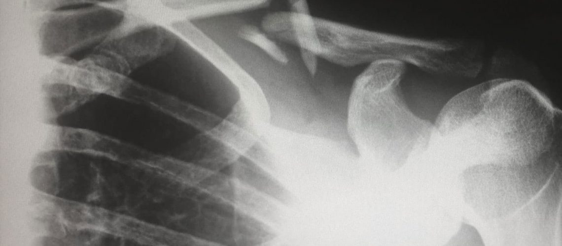 an x-ray of a broken shoulder bone